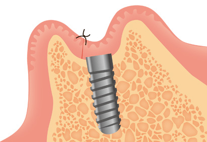 インプラント埋入手術(一次手術)