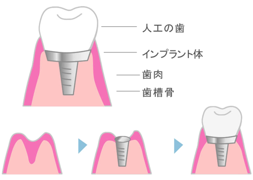 インプラント